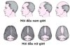 Nguyên nhân hói đầu ở cả nam giới và nữ giới