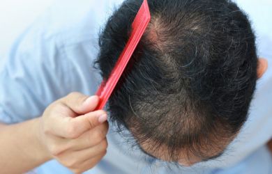 Tìm hiểu nguyên nhân rụng tóc nhiều ở đỉnh đầu